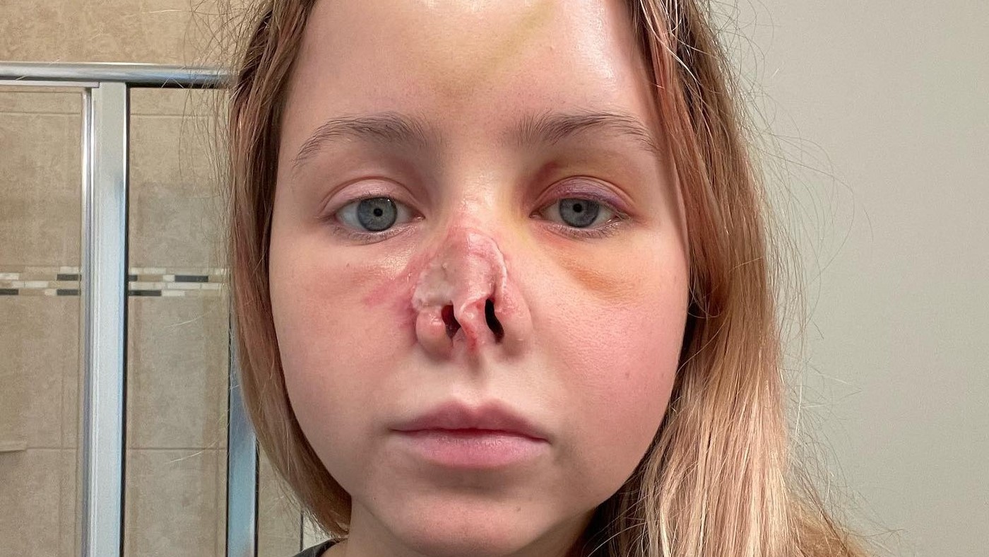 utok psa odhryznuty nos